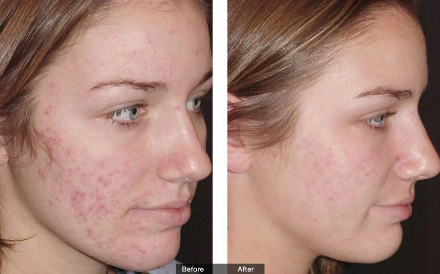 Acne removal before after 1