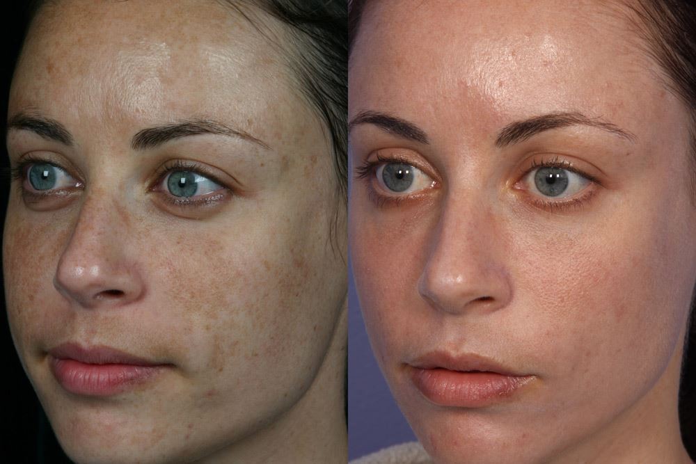 Pigment before after 1