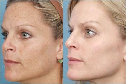 Skin rejuvenation
