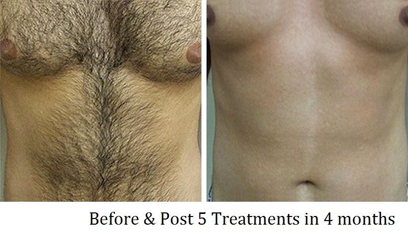 Hair Removal Before After 4