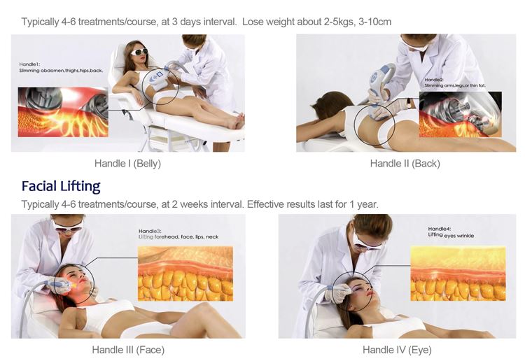 velashape slimming machine